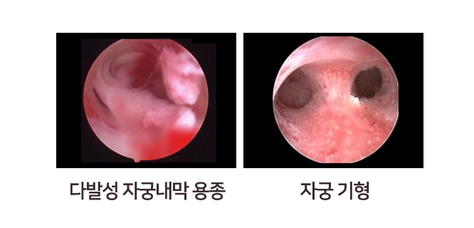 자궁경 사진